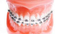 Roseville Braces
