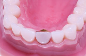 Roseville Tooth Crown Dentist