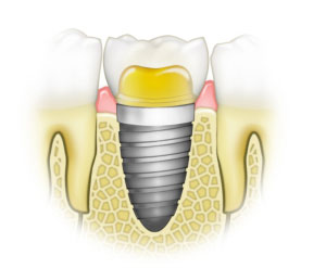 Roseville Dental Implants