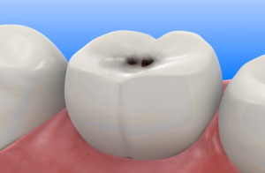 Roseville Dentist Tooth Filling