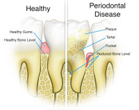 Roseville Gum Disease