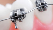 Roseville Dentistry Braces