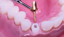 Roseville Root Canals