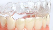 Roseville Teeth Whitening