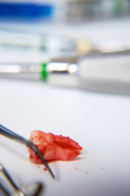 Roseville Dental Wisdom Teeth