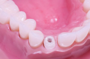 Roseville Root Canal