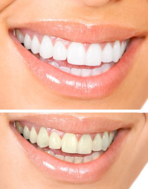 Roseville Teeth Whitening